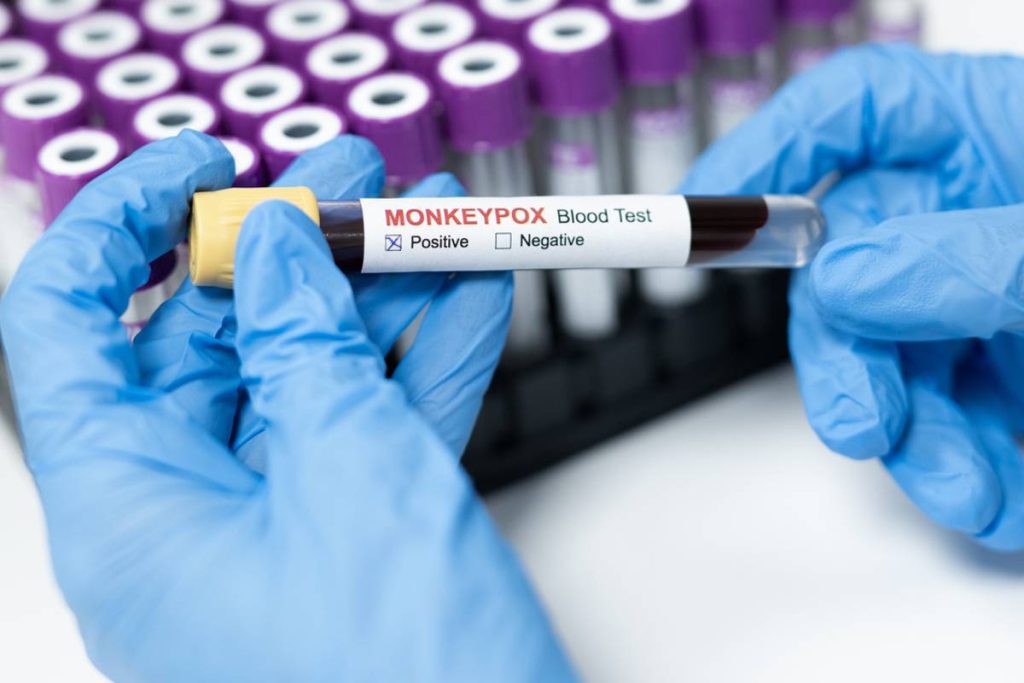 المغرب يؤجل مؤتمرا دوليا للصحة العامة بسبب تفشي مرض جدري القرود