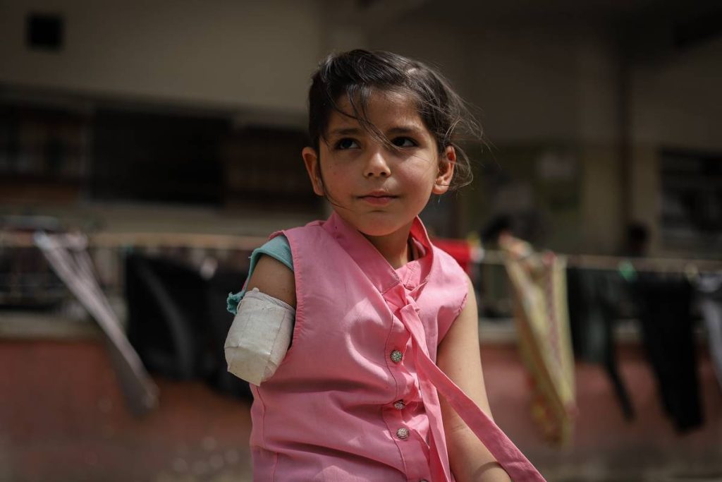 وزارة الصحة في غزة: أدت حرب الإبادة الجماعية إلى بتر 1000 من أطراف الأطفال الفلسطينية