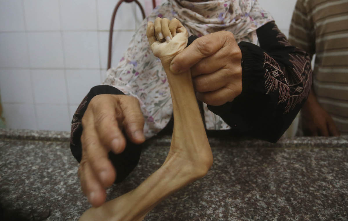 فقدت الفتاة الفلسطينية البالغة من العمر أربع سنوات رزان أبو زاهر حياتها بسبب سوء التغذية الشديد ونقص طعام الأطفال ، في 20 يوليو 2025 في دير البلاه ، غزة. (Ashraf Amra - Anadolu Agency)