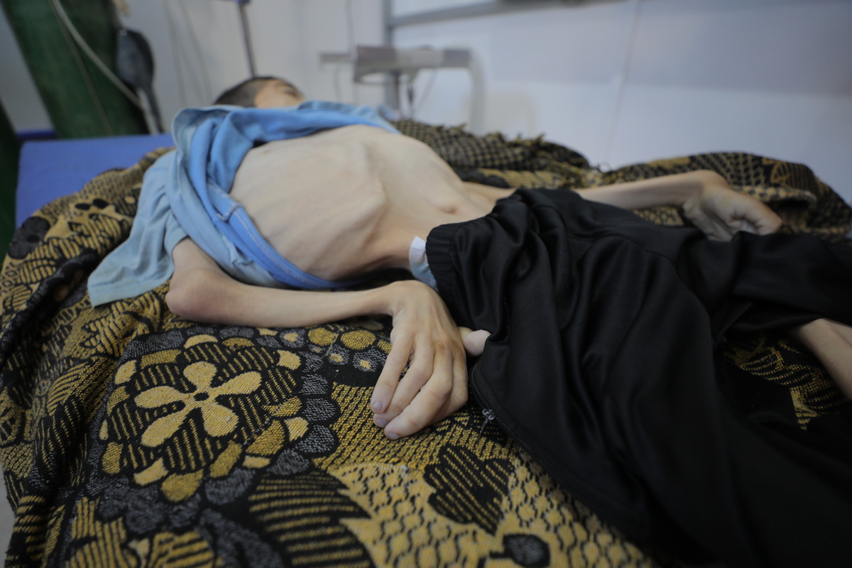 تم إحضار جثة من الفلسطيني الفلسطيني كرام خالد الجمال ، الذي فقد حياته بسبب سوء التغذية ، إلى مستشفى العودا في معسكر نوسائر في مدينة غزة ، غزة في 31 يوليو 2025.