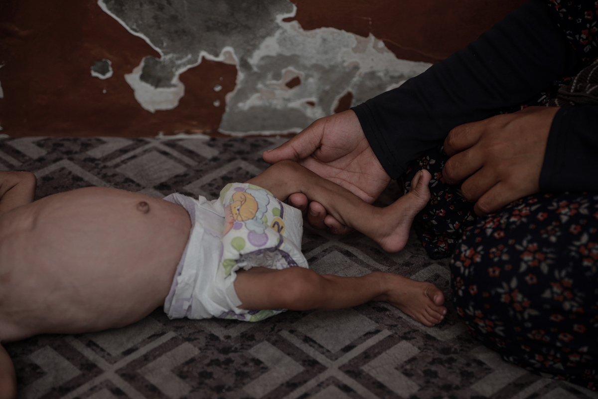 طفل فلسطيني يبلغ من العمر خمسة أشهر ، عمار محمد عمارة ، يعاني من ارتفاع مستمر وسوء التغذية الشديد منذ الولادة بسبب هجمات إسرائيل المستمرة والحصار في مدينة غزة ، غزة في 6 أغسطس 2025.