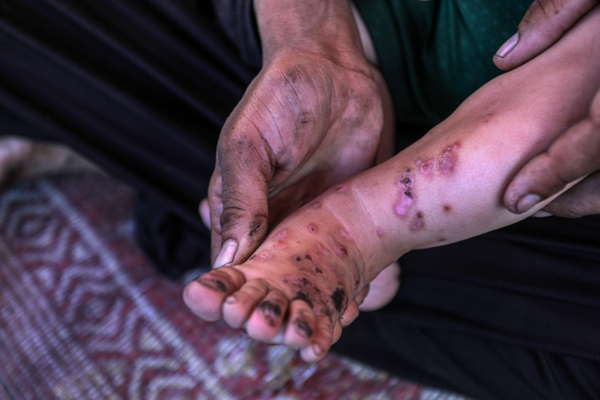 أم محمد الماسري ، لاجئ فلسطيني وأم لخمسة ، ملاجئ في مبنى جامعة أقبية ، وطفلها البالغ من العمر 10 أشهر ، رمضان الماسري ، يعاني من عدوى الجلد البكتيرية التي تنتقل عبر الدم ، في غزة في 12 أغسطس 2025.