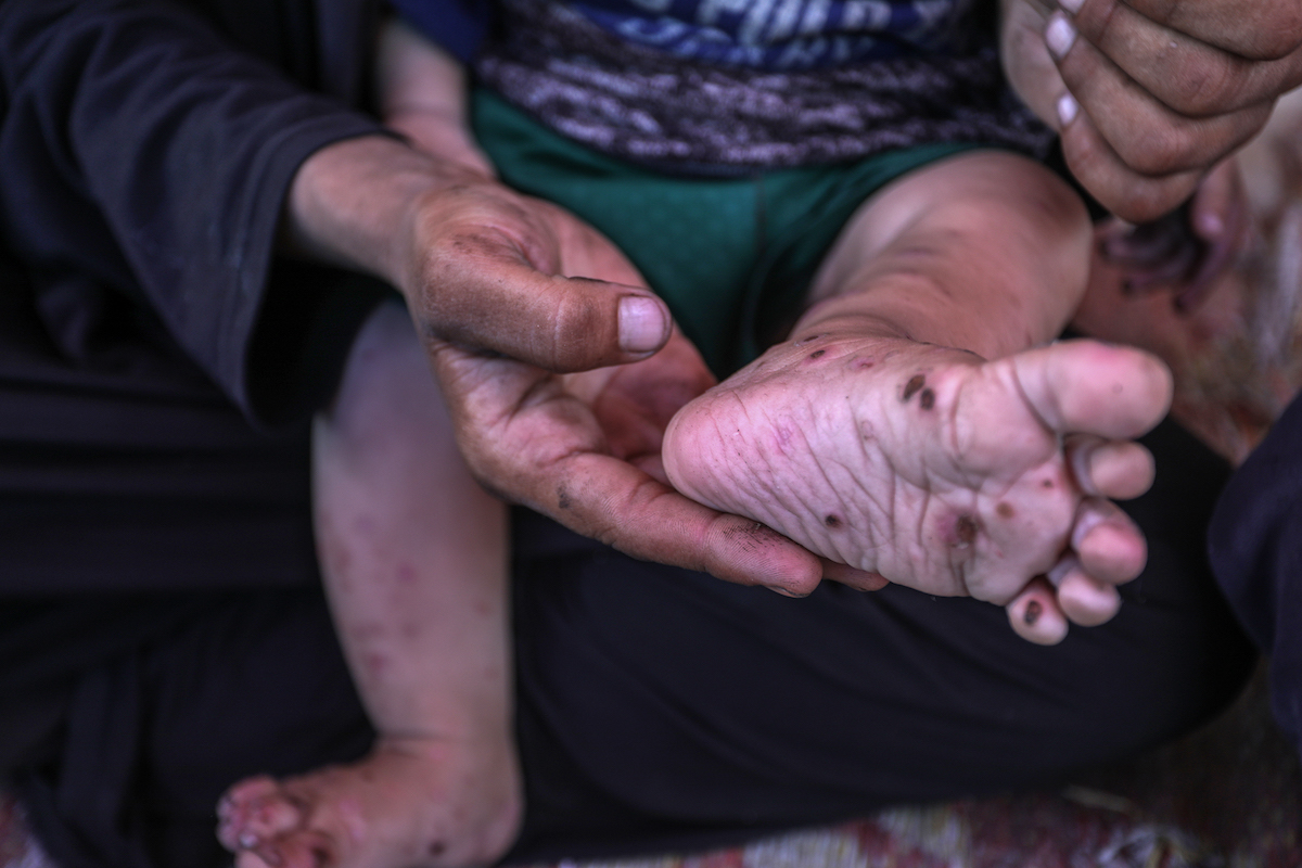 أم محمد الماسري ، لاجئ فلسطيني وأم لخمسة ، ملاجئ في مبنى جامعة أقبية ، وطفلها البالغ من العمر 10 أشهر ، رمضان الماسري ، يعاني من عدوى الجلد البكتيرية التي تنتقل عبر الدم ، في غزة في 12 أغسطس 2025.