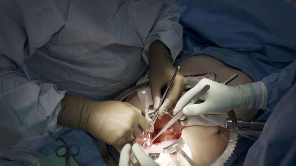 بدء أول تجربة سريرية لزراعة كلى الخنازير